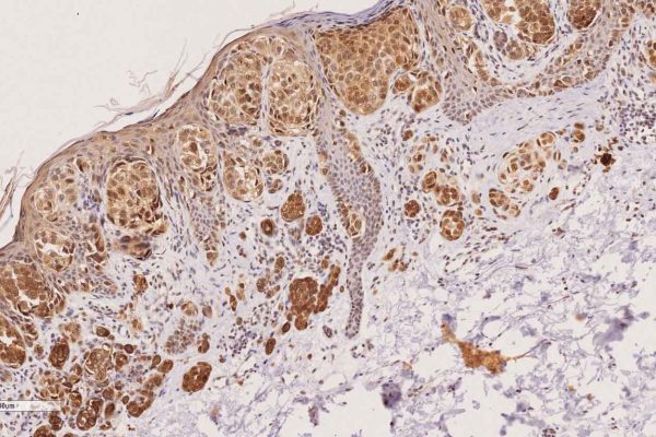 Pirin-staining-in-superficial-spreading-melanoma-biopsy-cancer-and-translational-medicine